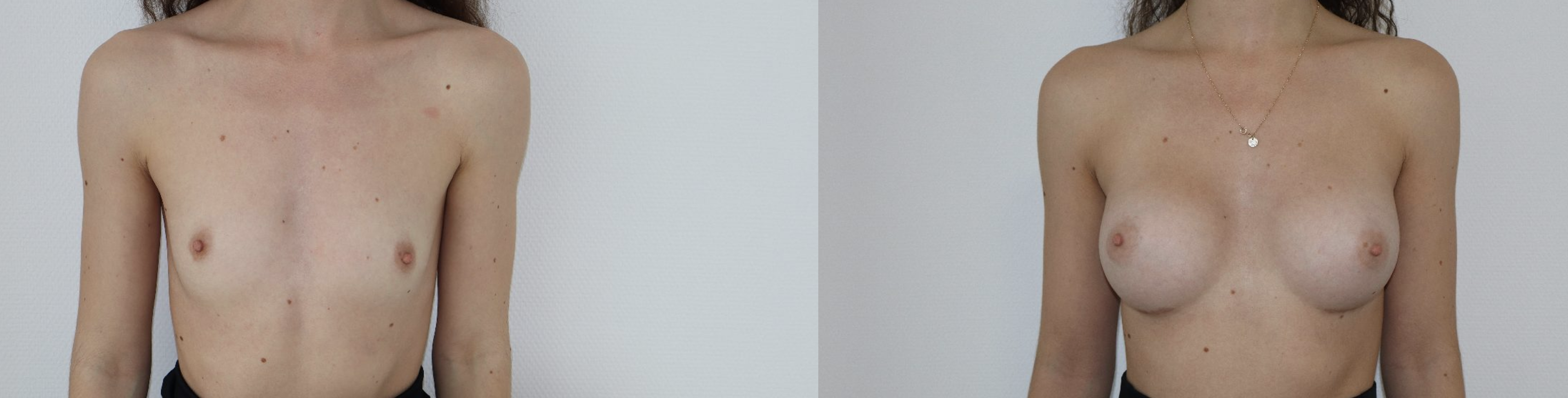 Avant/Après prothèses mammaires